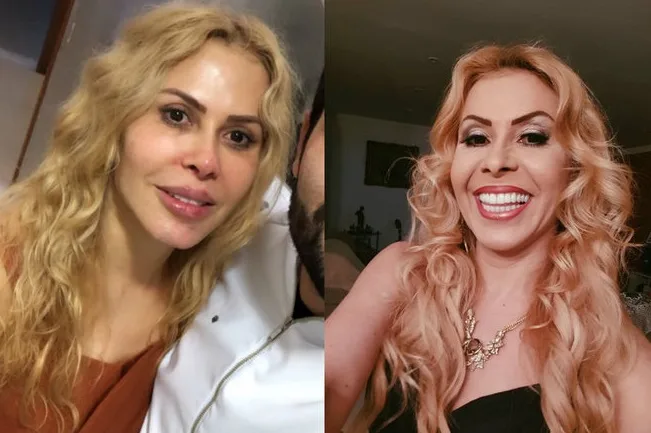 Joelma faz preenchimentos com médico de Gretchen e surpreende