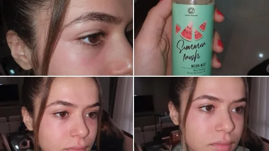 Maisa Silva tem reação alérgica após usar creme facial que ganhou de presente