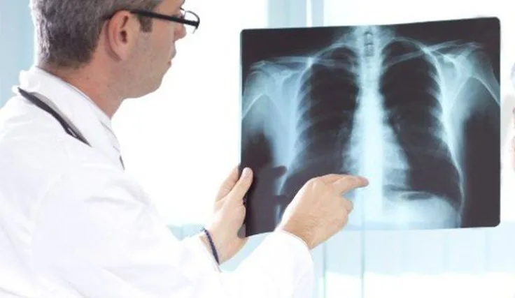 Remédio para hipertensão pulmonar poderá ter distribuição gratuita