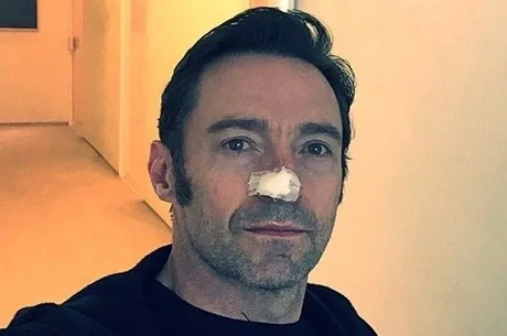 Hugh Jackman, astro de Wolverine, é submetido a novo tratamento contra câncer de pele