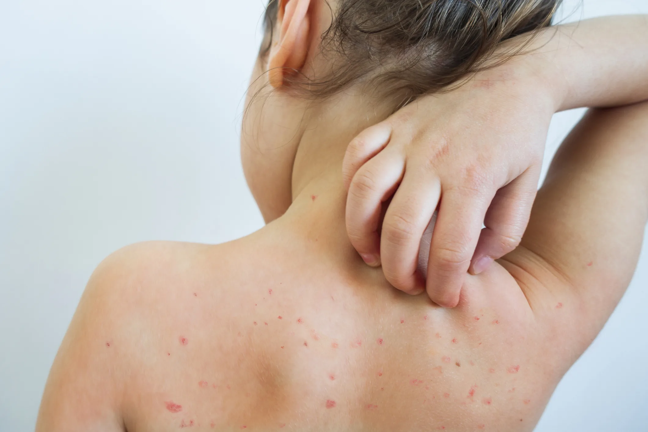 Young girl with measles virus.