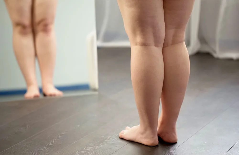 Lipedema: entenda o que é a doença, quais os sintomas e tratamentos