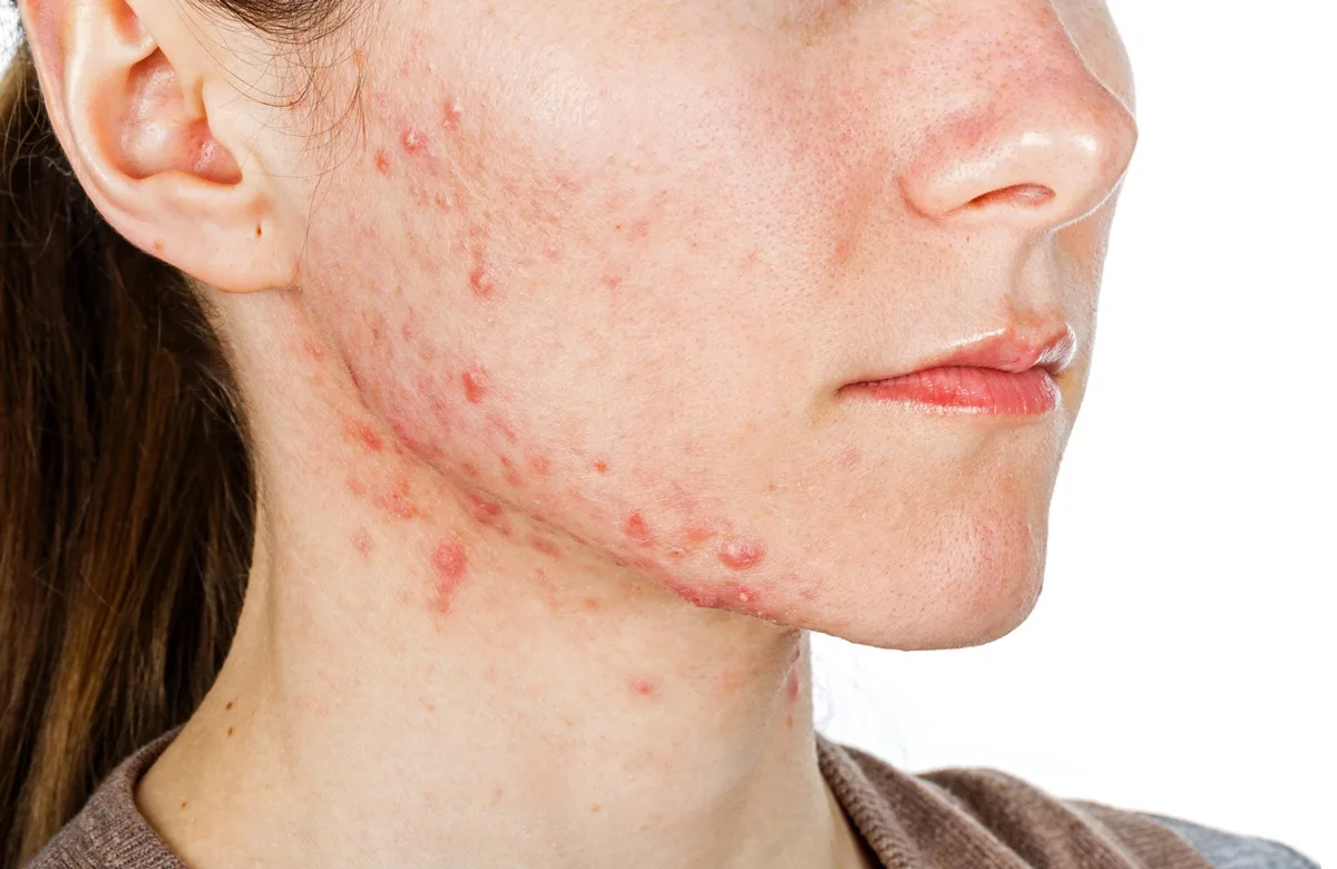 Portrait of young girl with skin problem