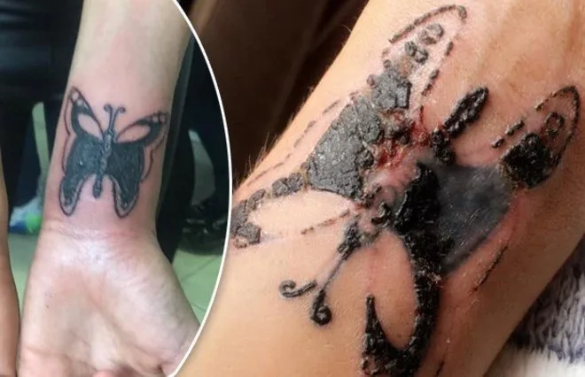 Jovem faz tatuagem e acorda sem conseguir mexer o braço