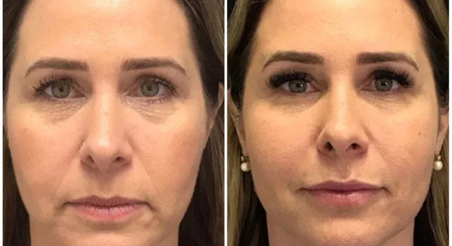 Andréa Sorvetão mostra resultado de harmonização facial