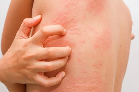 Women with symptoms of itchy urticaria.