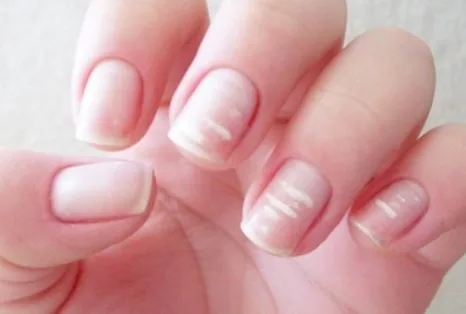 Manchas e rachaduras: 6 sinais nas unhas que podem indicar doenças