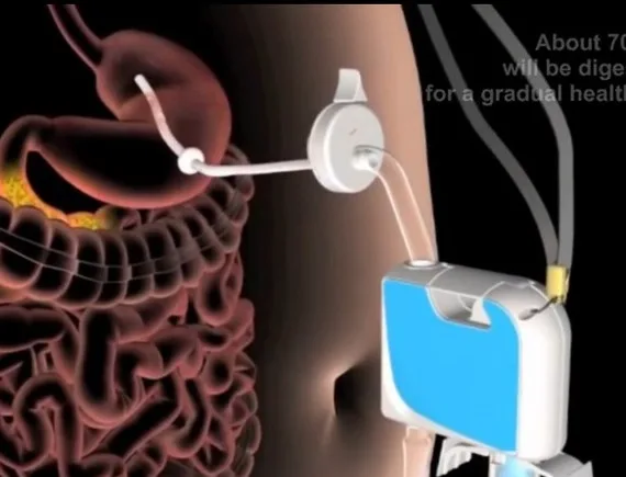 Endocrinologista alerta para riscos de aparelho que permite "comer sem engordar"