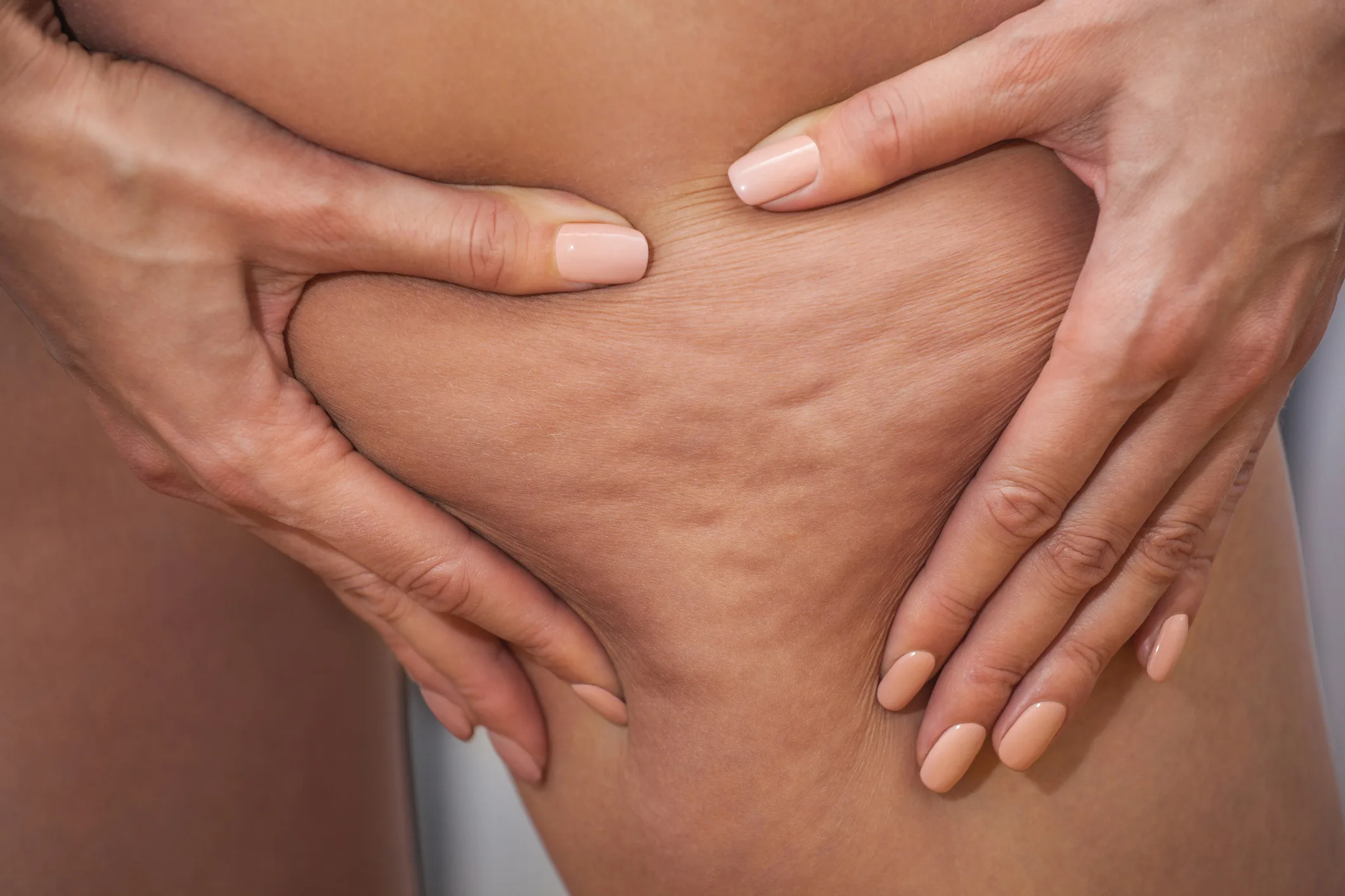 Girl shows holding and pushing the skin of the legs cellulite, orange peel. Treatment and disposal of excess weight, the deposition of subcutaneous fat tissue