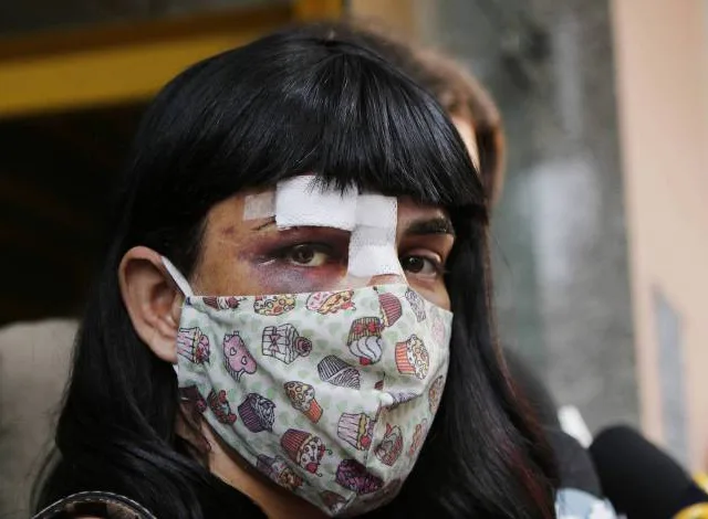 Modelo trans capixaba inicia tratamento de reconstrução do rosto após agressão