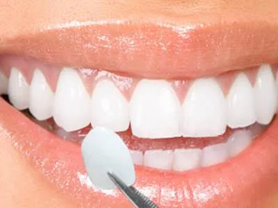 Lente de contato dental é a nova moda para quem busca um sorriso perfeito