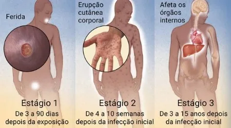 Espírito Santo é o segundo estado com maior número de casos de sífilis adquirida do Brasil