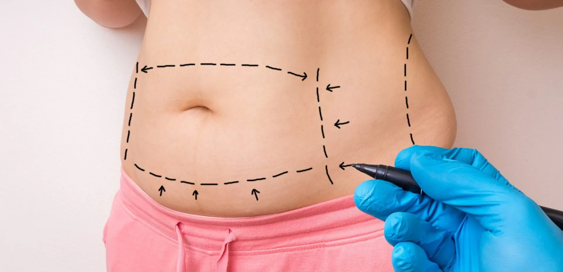 Abdominoplastia está entre as principais cirurgias realizadas no Brasil. Entenda o procedimento!