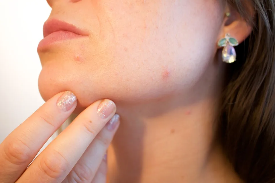 Já ouviu falar em acne adulta? Problema atinge principalmente mulheres