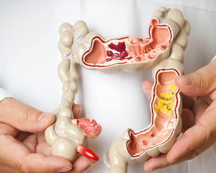 Saiba quais alimentos aumentam o risco de câncer no intestino