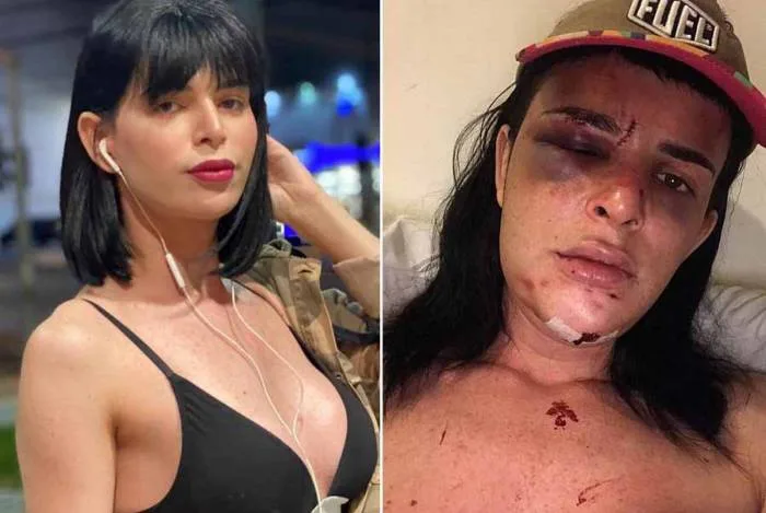 Modelo trans capixaba fica com rosto deformado após ser agredida dentro de casa em Copacabana