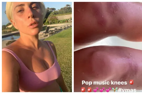 Lady Gaga aparece com hematomas e vermelhidão pelo corpo