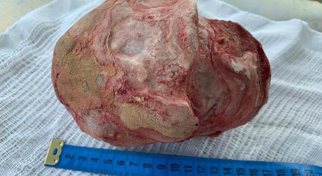 Pedra vesical de 18 cm e 1,3 Kg é retirada da bexiga de lavrador