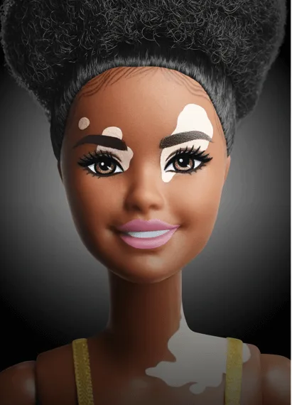 Barbie lança bonecas com vitiligo e sem cabelo