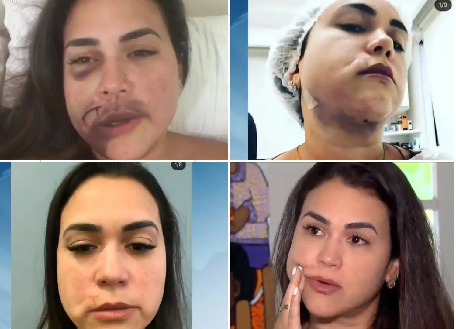 Jovem agredida por modelo em restaurante de luxo exibe marcas: 'A cicatriz fala comigo'