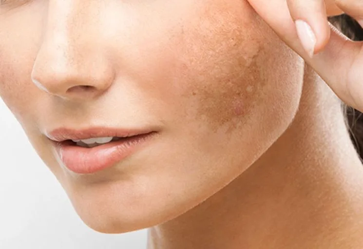 Melasma: entenda as causas e saiba como tratar as manchas no outono