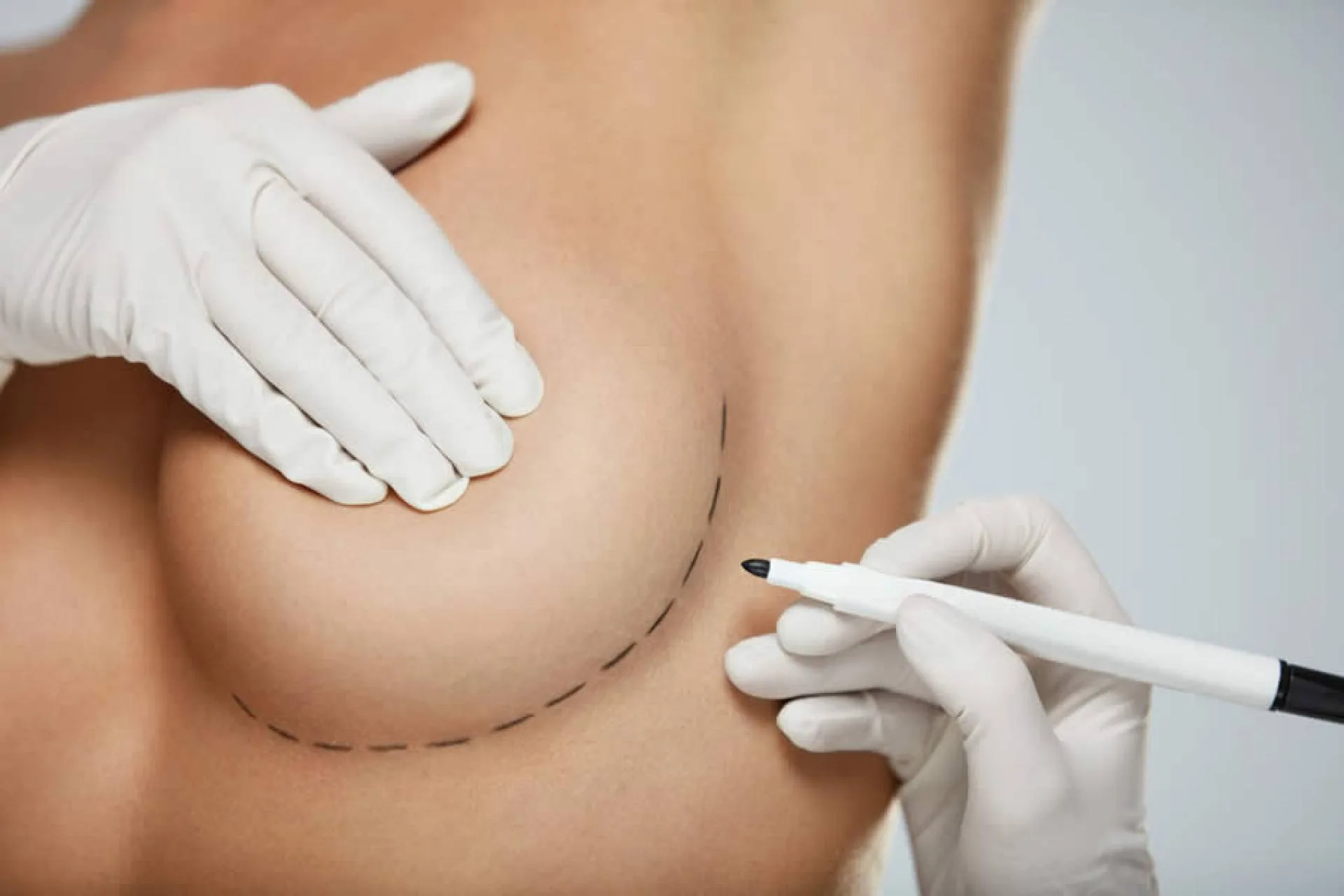 Tendência: mamoplastia híbrida garante resultados mais naturais