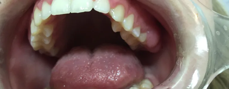 Pessoas diabéticas possuem mais chance de desenvolver doenças periodontais