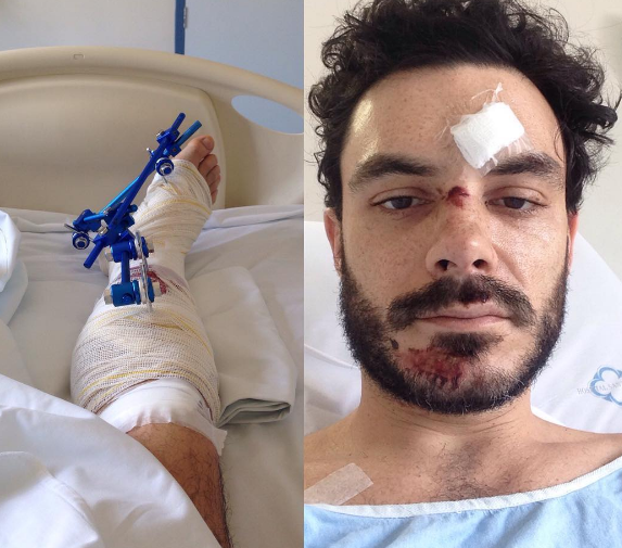 Ator Kiko Pissolato sofre acidente de bicicleta: "Poderia ter morrido"