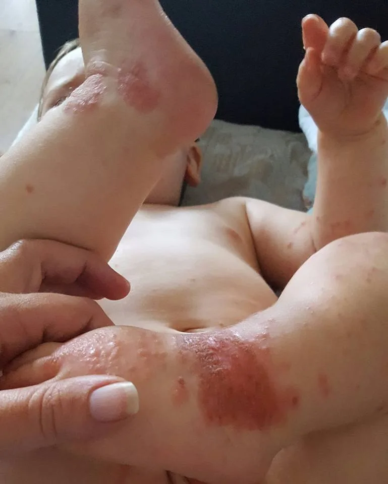 Bebê contrai herpes após ser beijado e mãe faz desabafo na internet