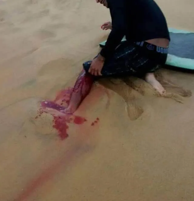 Foto com suposto ataque de tubarão preocupa surfistas e banhistas em Guarapari