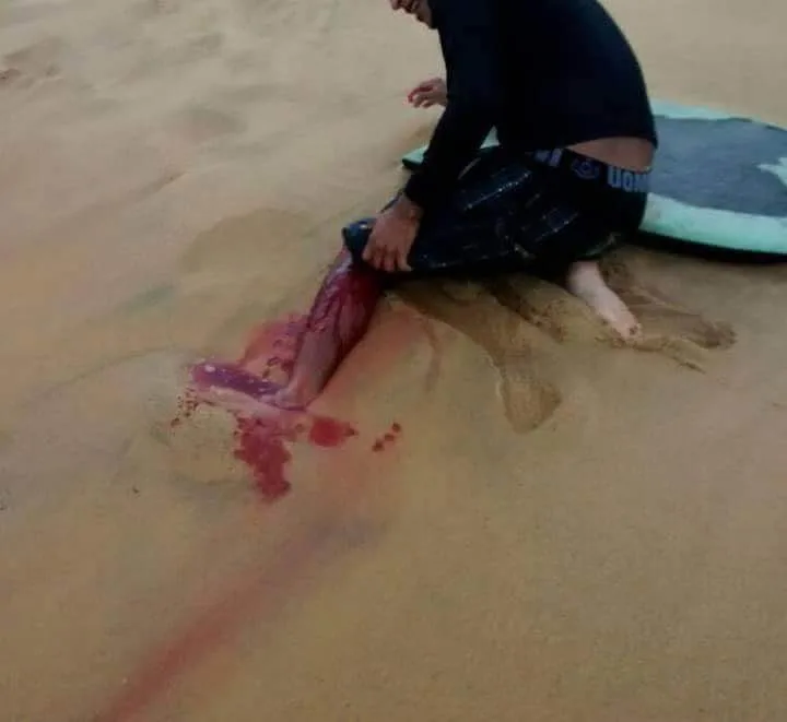 Foto com suposto ataque de tubarão preocupa surfistas e banhistas em Guarapari