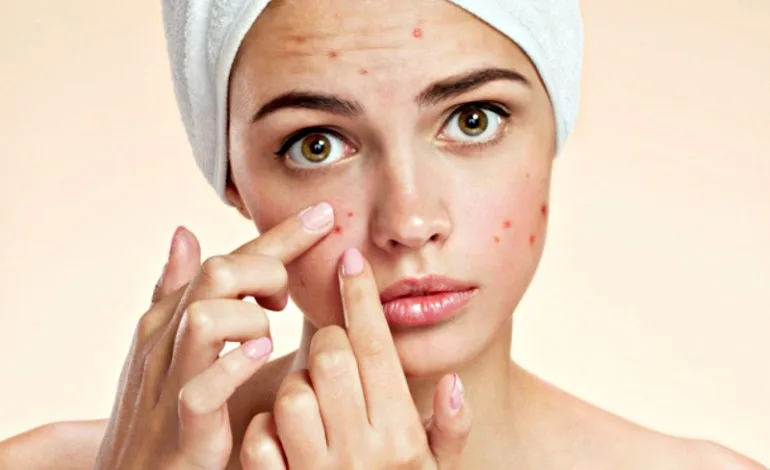 Acne atinge mais da metade da população adulta e 90% dos adolescentes