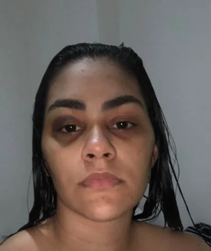 Cantora sertaneja denuncia agressão do marido e expõe fotos dos hematomas nas redes sociais