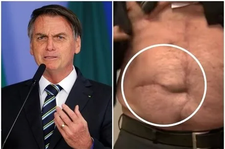 Jair Bolsonaro vai passar por nova cirurgia; entenda o procedimento