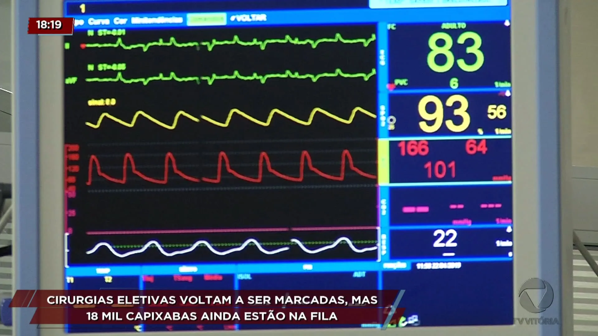 Cirurgias eletivas voltam a ser marcadas, mas 18 mil capixabas ainda estão na fila