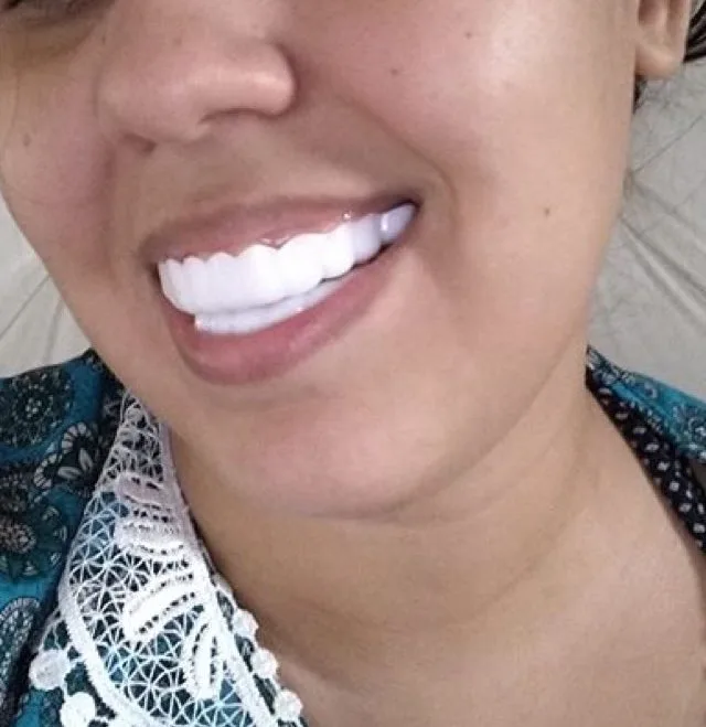 "Boquinha pelada?": mulher compra dentadura de lente de dentes e viraliza