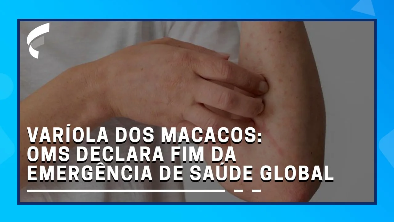 Varíola dos Macacos: OMS declara fim da emergência de saúde global da Mpox