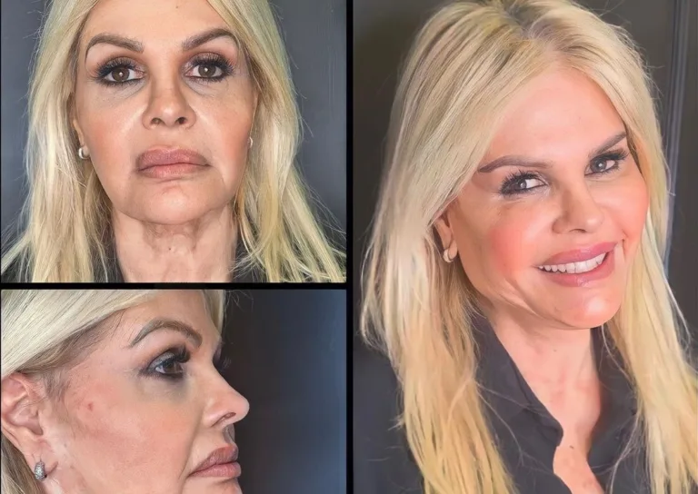 Após fazer harmonização facial, Monique Evans mostra resultado