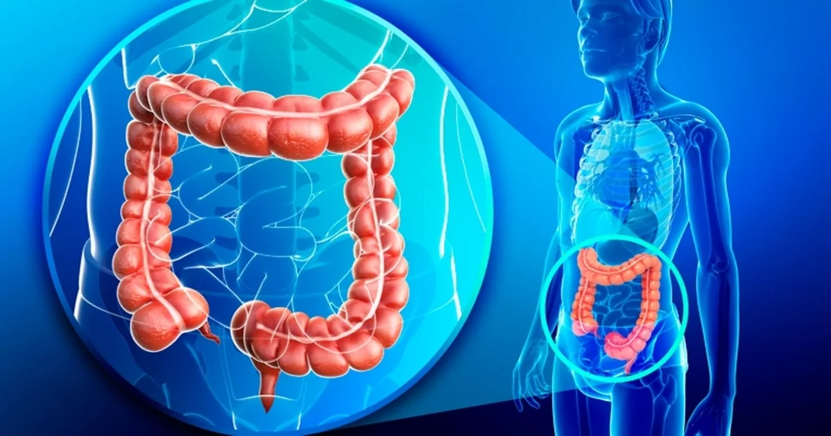 Doença de Crohn: Saiba o que é e como tratar