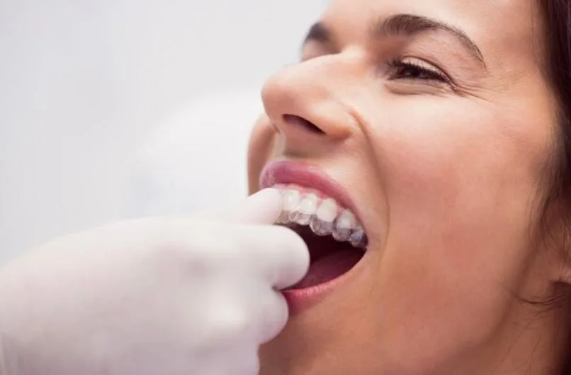 O aparelho ortodôntico amarela os dentes? Entenda