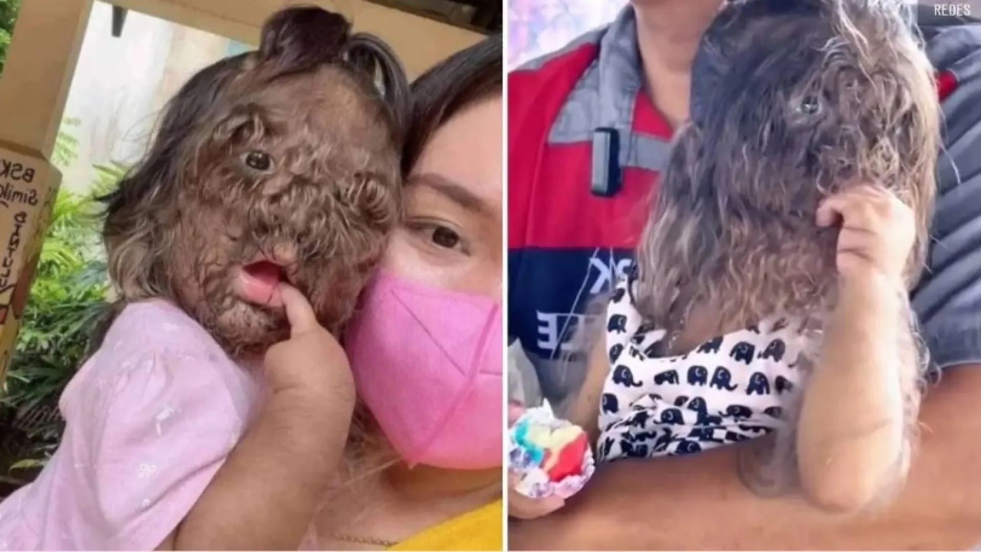 O que é síndrome do lobisomem? Menina de 2 anos sofre preconceito por doença rara