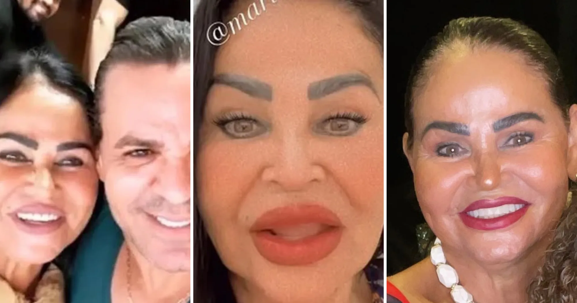 Mãe de Eduardo Costa exibe visual após harmonização facial; veja antes e depois