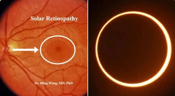 "Efeito das 48 horas": brasileiros relatam problemas de visão após eclipse solar raro