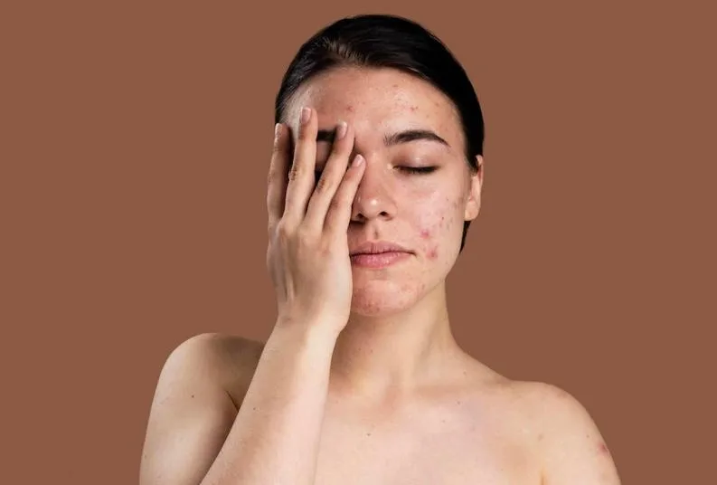 Acne: conheça causas, tratamentos eficazes e erros comuns