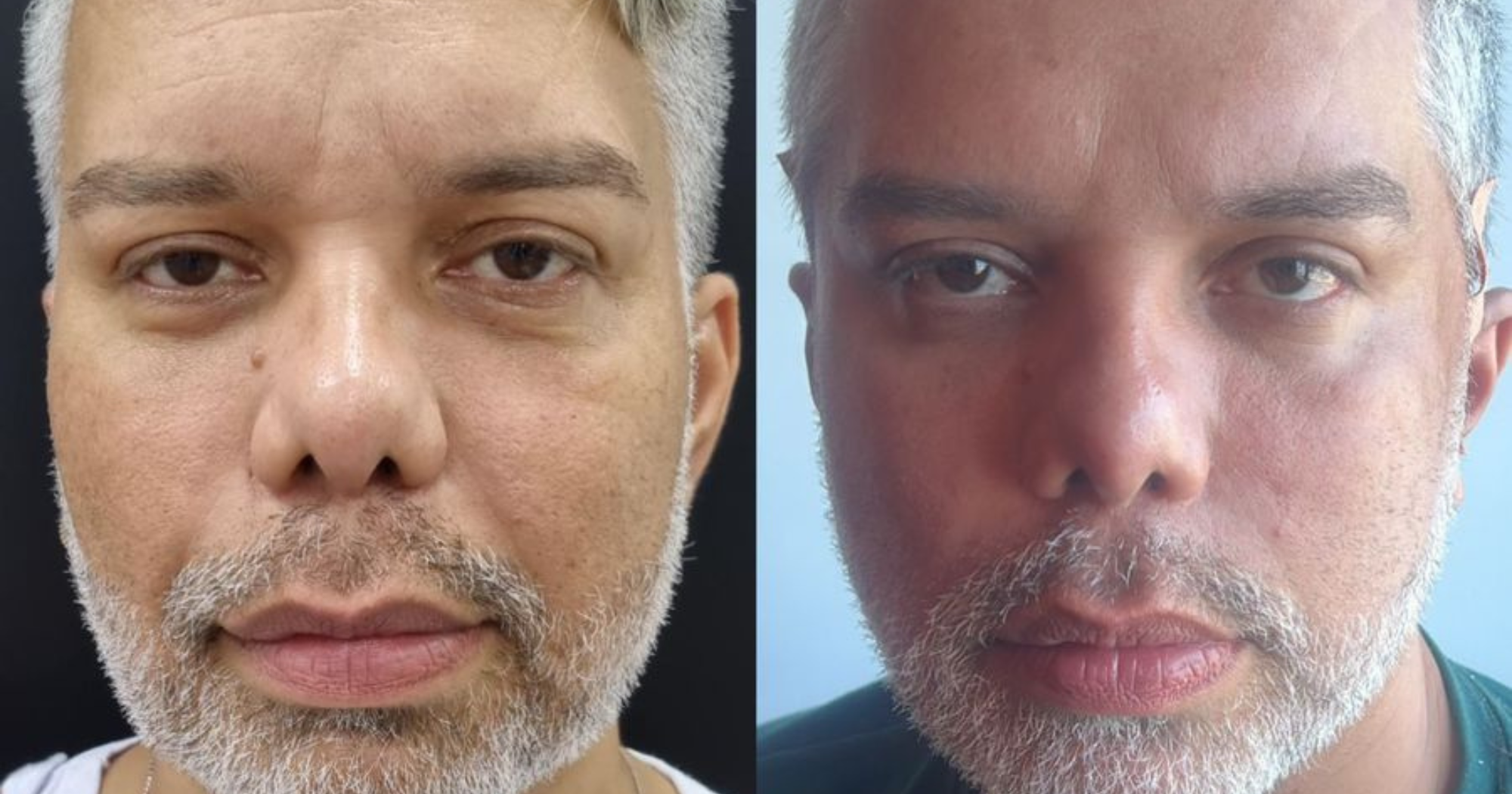 Influencer faz tratamento estético para tirar rugas; antes e depois