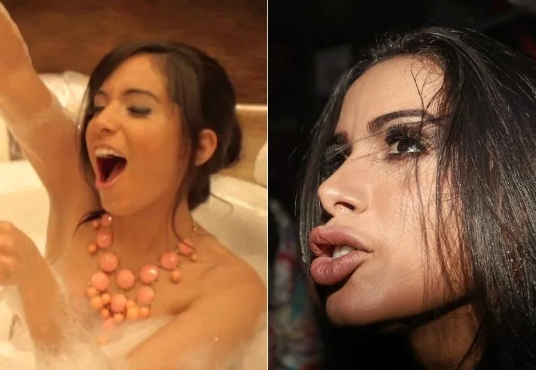 Pela primeira vez, Anitta fala sobre botox: "Não fico preocupada se o povo vai falar"