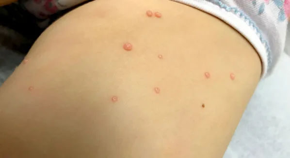 Infecção do molusco contagioso atinge crianças e adultos