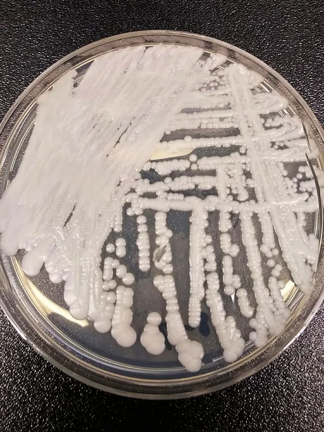 Anvisa alerta para 1º caso de fungo superresistente no Brasil