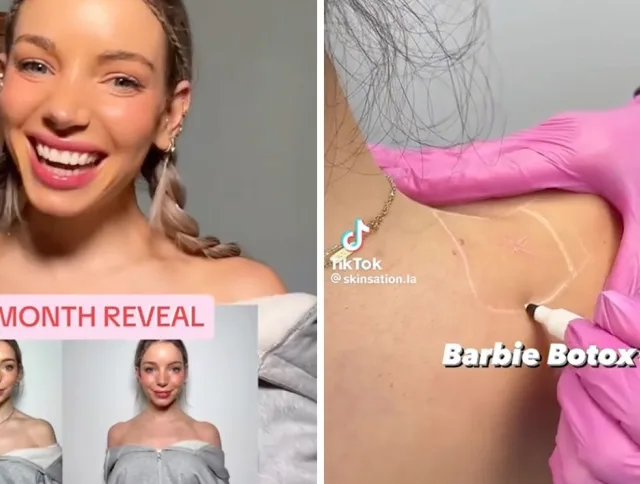 Viralizou: o que é Botox da Barbie do TikTok, novo "perigo" da beleza