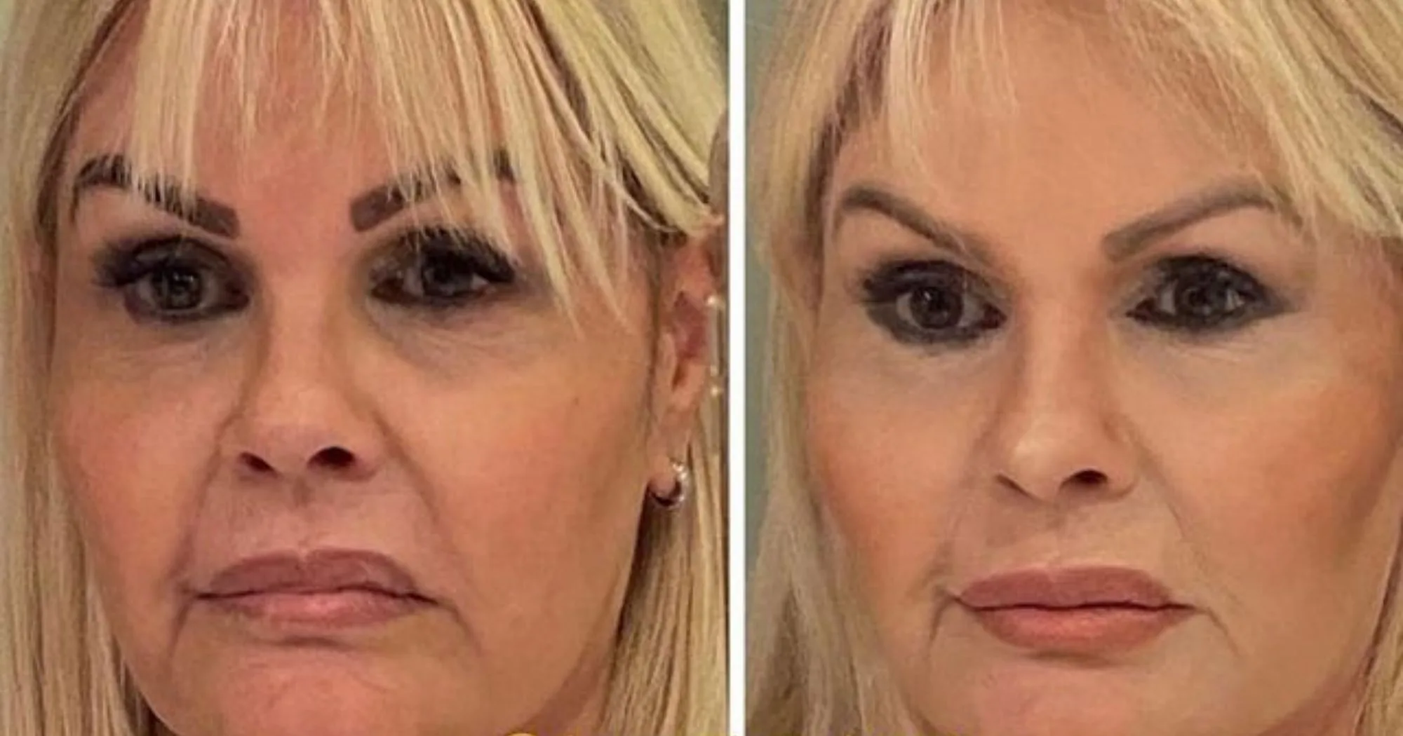 Monique Evans impressiona com 'antes e depois' de harmonização feita no ES